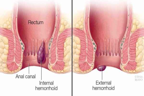 hemorrhoid-cancer-pictures-hemorrhoids-infographics-showing-symptoms-hypes-Piles