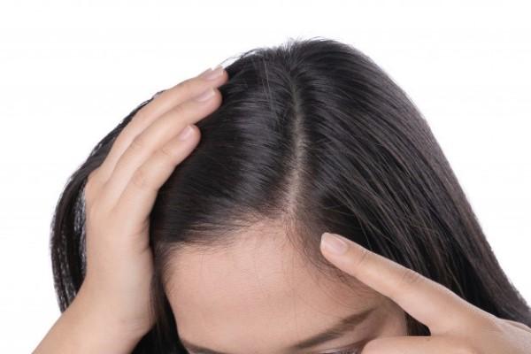 young-asian-women-worry-about-problem-hair-loss-head-bald-dandruff
