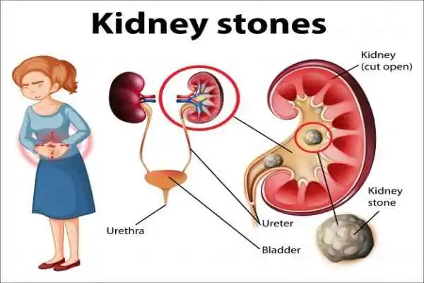 informative-illustration-kidney-stones