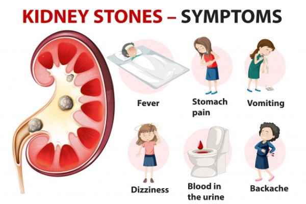 kidney-stones-symptoms-cartoon-style-infographic