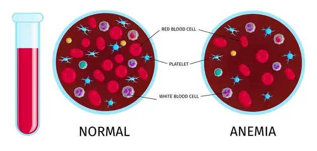 blood-test-with-anemia-infographic