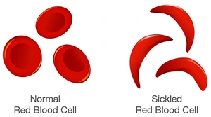 Infographic for Normal cell and Sickled red blood cell