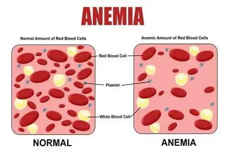 Normal and anemic blood cells