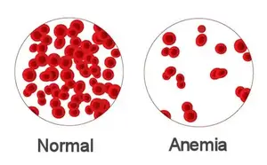 The difference between Anemia amount of red blood cells and normal