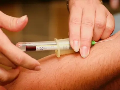 Taking a blood sample to detect the malaria parasite