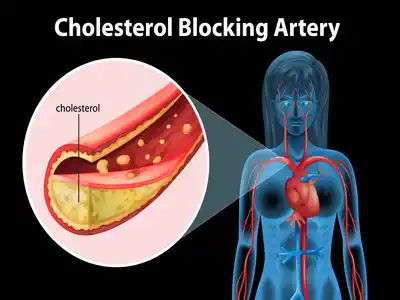 Cholesterol blocking artery