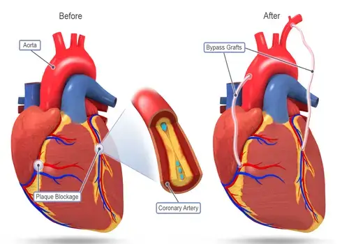 coronary-artery-bypass-grafting