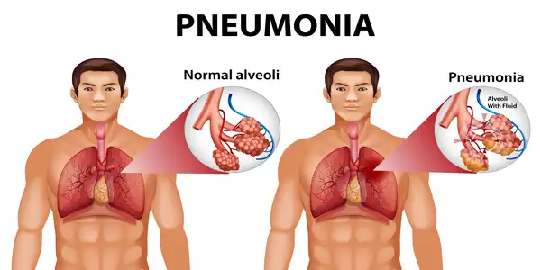 normal-and-affected-lungs-with-pneumonia-anatomy