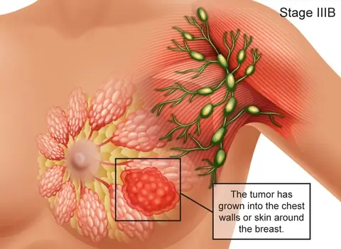 breast-cancer-stage-IIIB-large