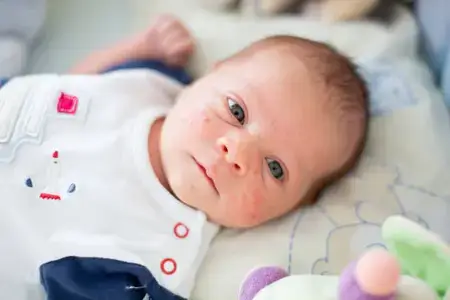 cute-newborn-baby-eczema-rash-on-his-face