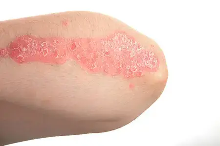 eczema-dermatological-diseases