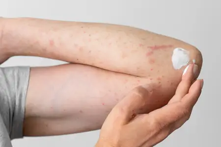 skin-allergy-reaction-person-arm