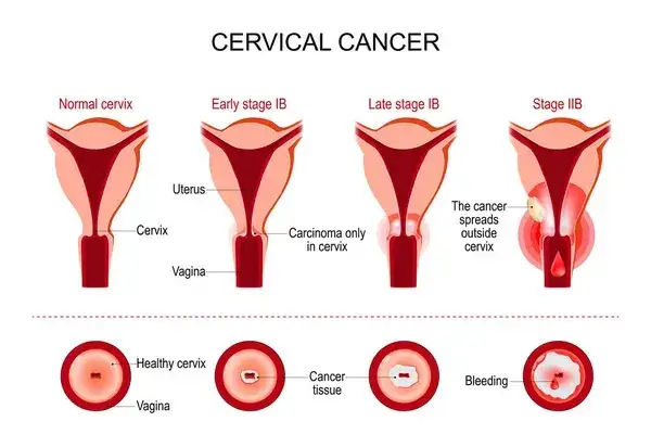 cervical-cancer-cervix-carcinoma-development
