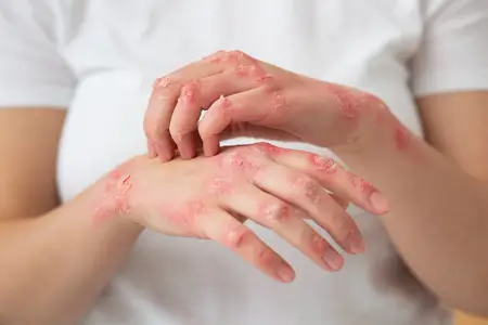 hands-patient-suffering-from-eczema