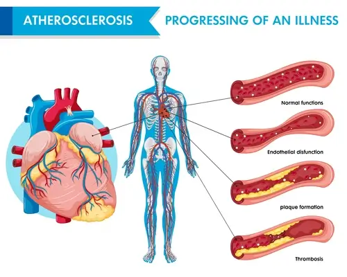 atherosclerosis-progression-of-an-illness
