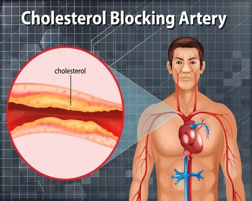 cholesterol-blocking-artery-in-human-body