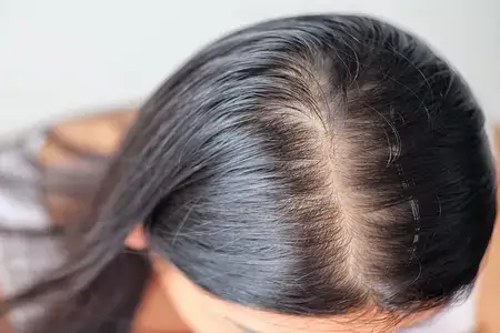 female-suffering-from-female-pattern-baldness