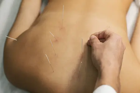 acupuncture-therapy-for-migraine-relief-and-prevention