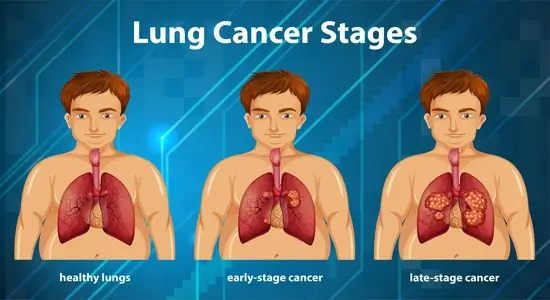 infographic-for-lung-cancer-stages