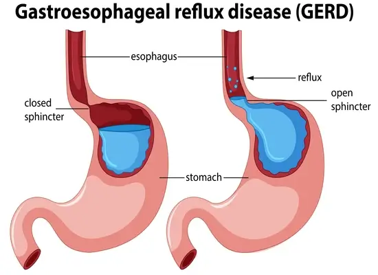 gastroesophageal-reflux-disease-gerd-infographic