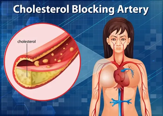 infographic-for-cholesterol-blocking-artery-in-human-body