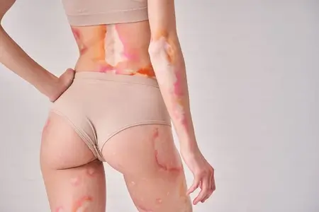 woman-having-skin-autoimmune-disease-rosacea