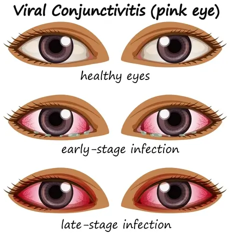 viral-conjunctivitis-in-human-eyes