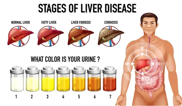 stages-of-fatty-liver-disease
