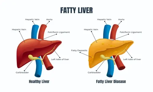 healthy-and-fatty-liver-illustration