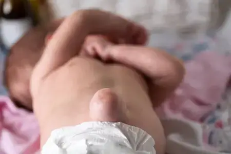 umbilical-hernia-near-the-navel-in-the-stomach-of-a-newborn-baby