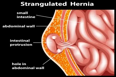 illustration-of-strangulated-hernia-for-education